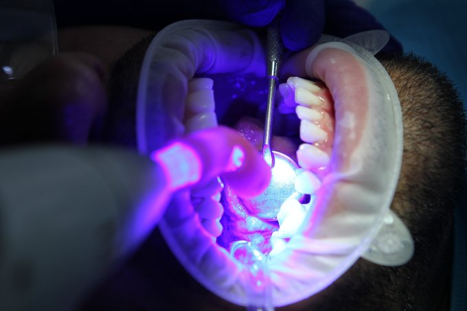 Wybielanie zębów u dentysty